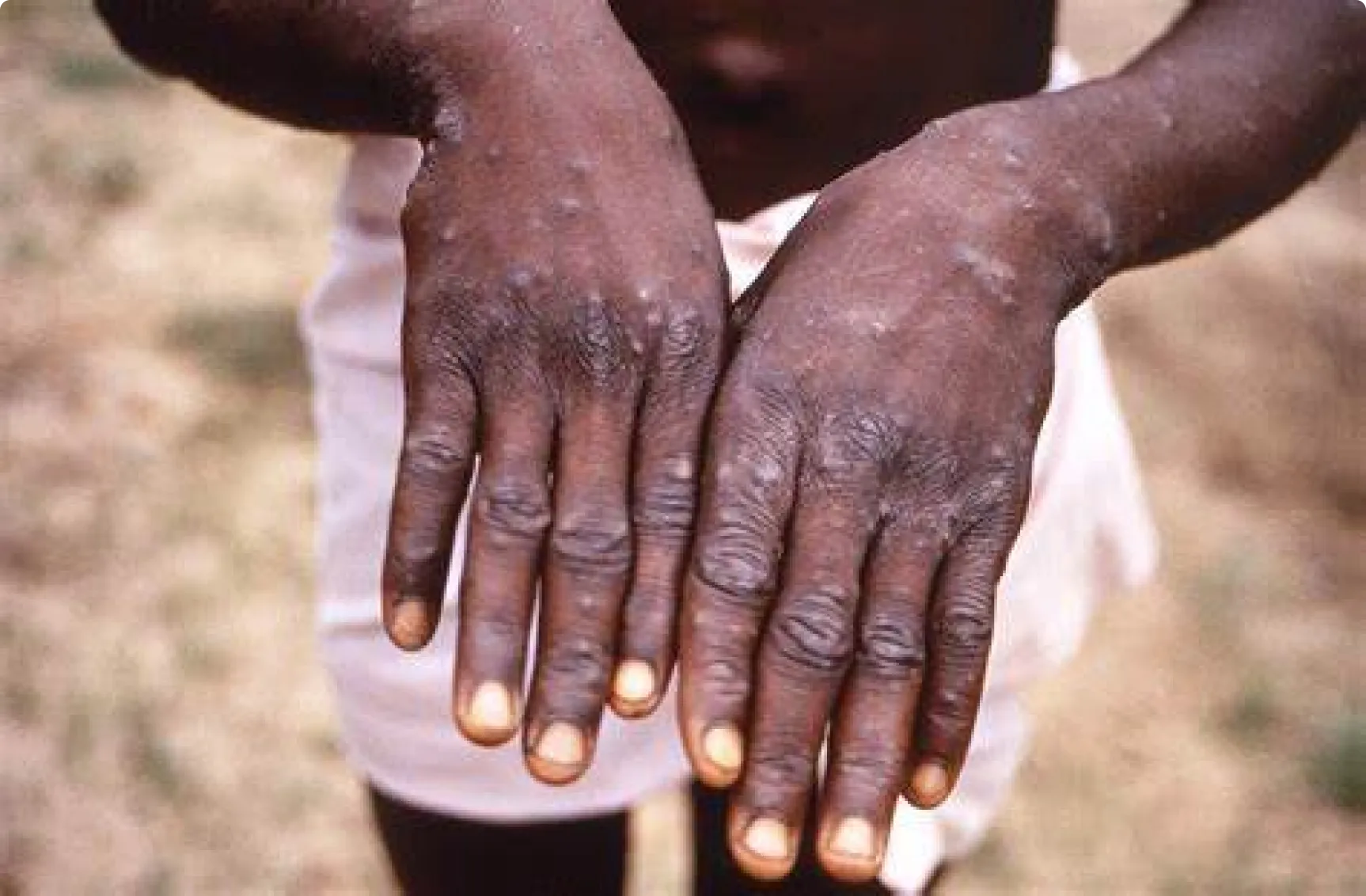 Cholera prevention